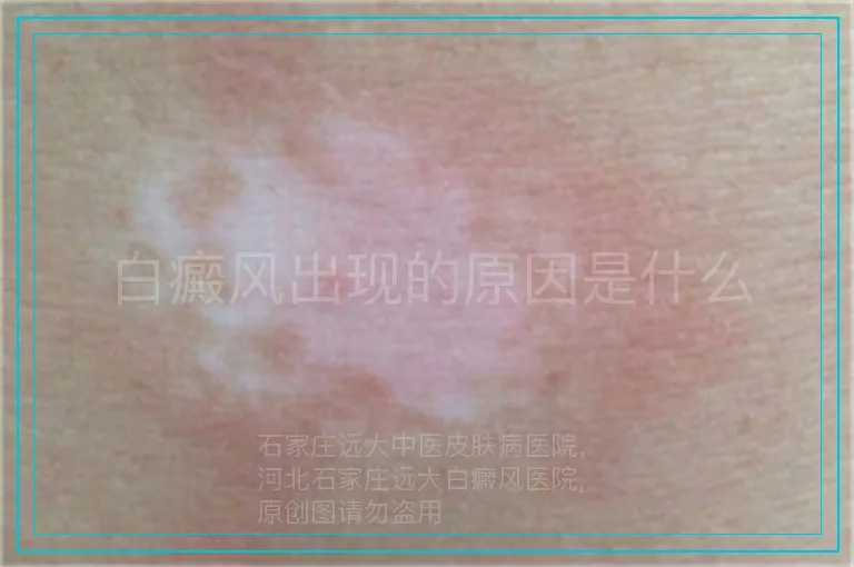 白癜风出现的原因是什么