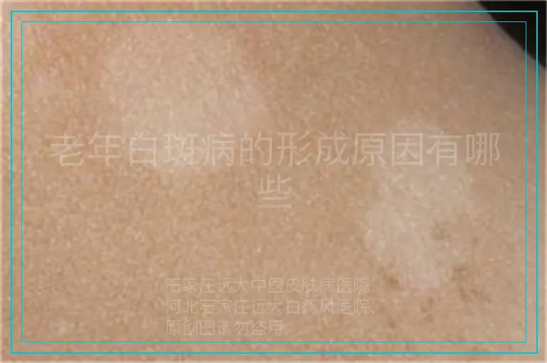 老年白斑病的形成原因有哪些
