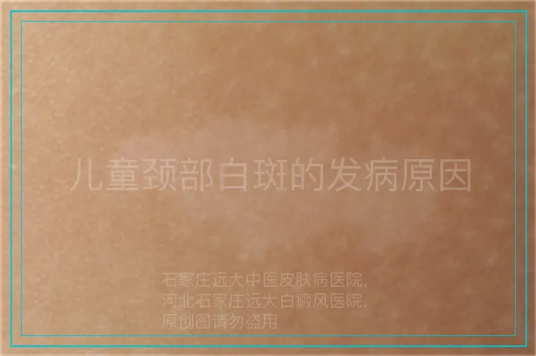儿童颈部白斑的发病原因