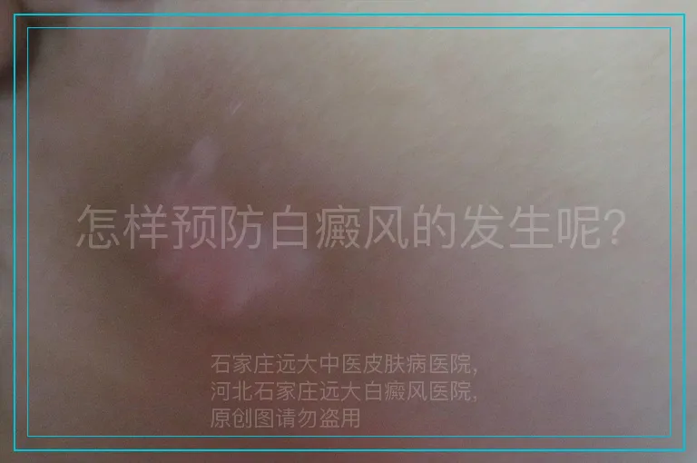怎样预防白癜风的发生呢？