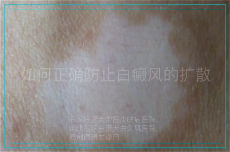 如何正确防止白癜风的扩散