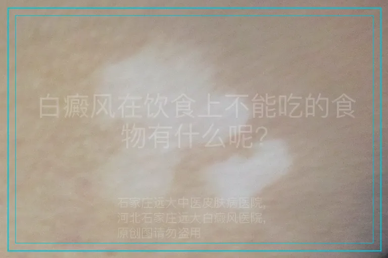 白癜风在饮食上不能吃的食物有什么呢?