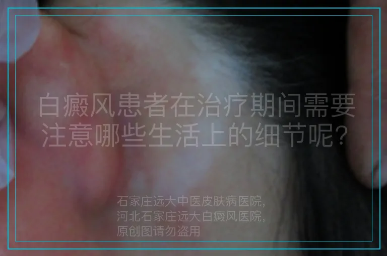 白癜风患者在治疗期间需要注意哪些生活上的细节呢?