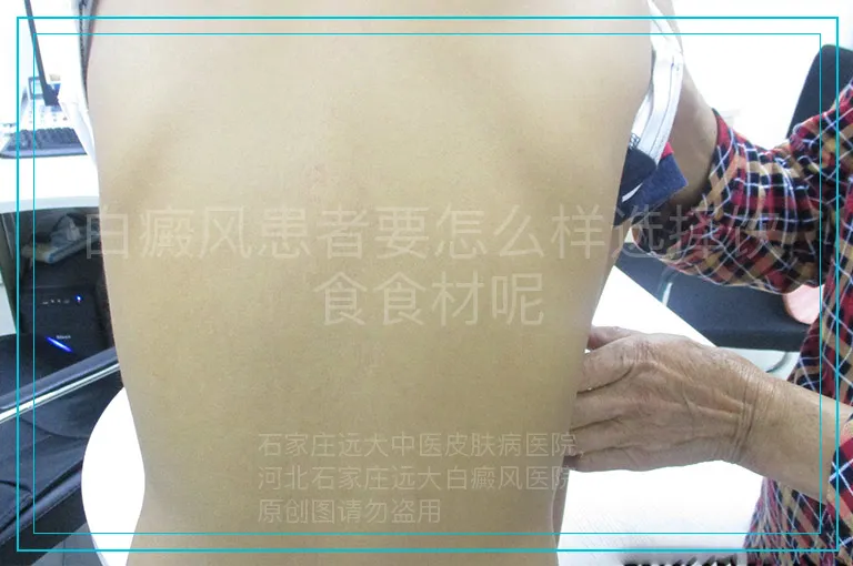 白癜风患者要怎么样选择饮食食材呢