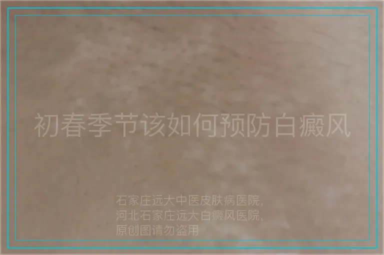 初春季节该如何预防白癜风