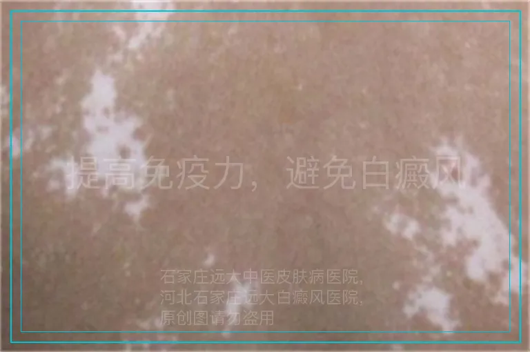 提高免疫力，避免白癜风