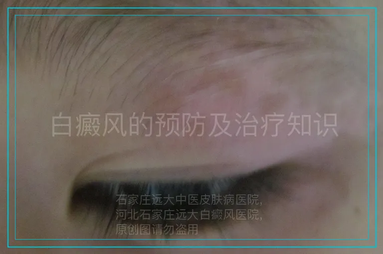 白癜风的预防及治疗知识
