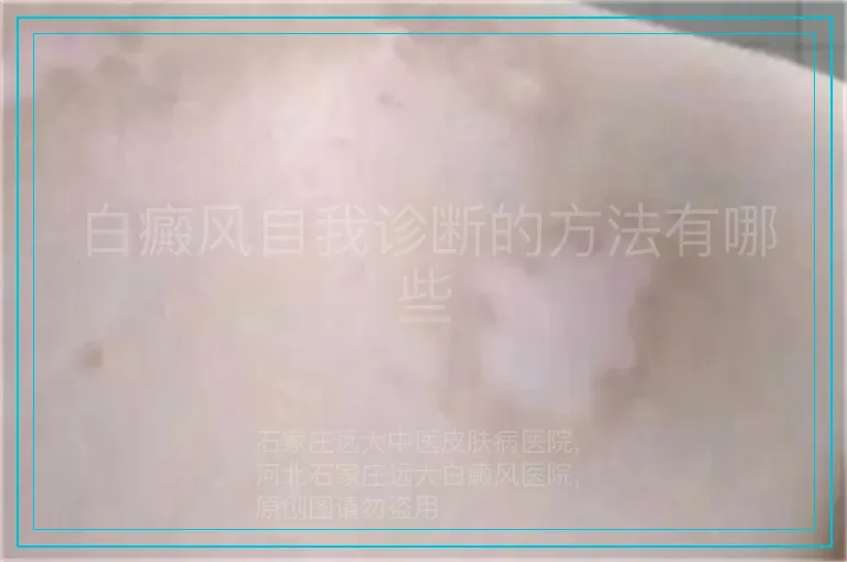白癜风自我诊断的方法有哪些