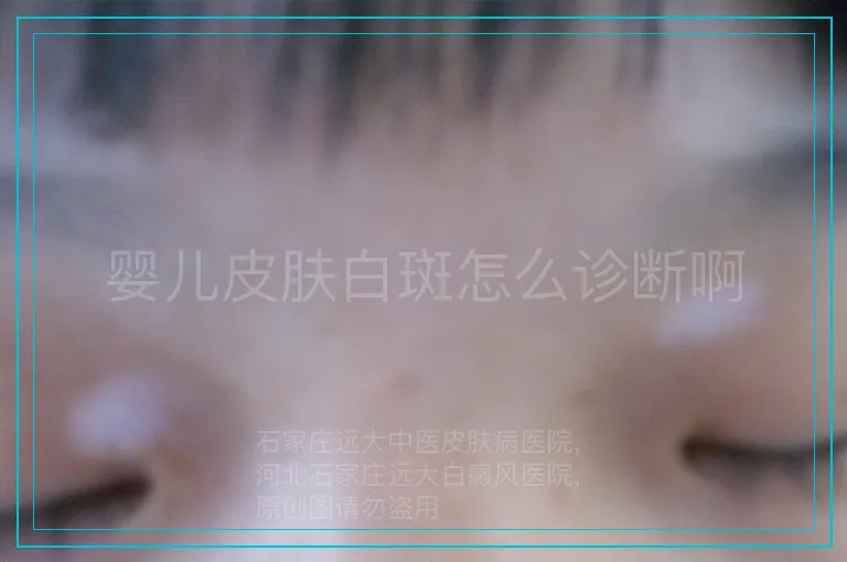 婴儿皮肤白斑怎么诊断啊