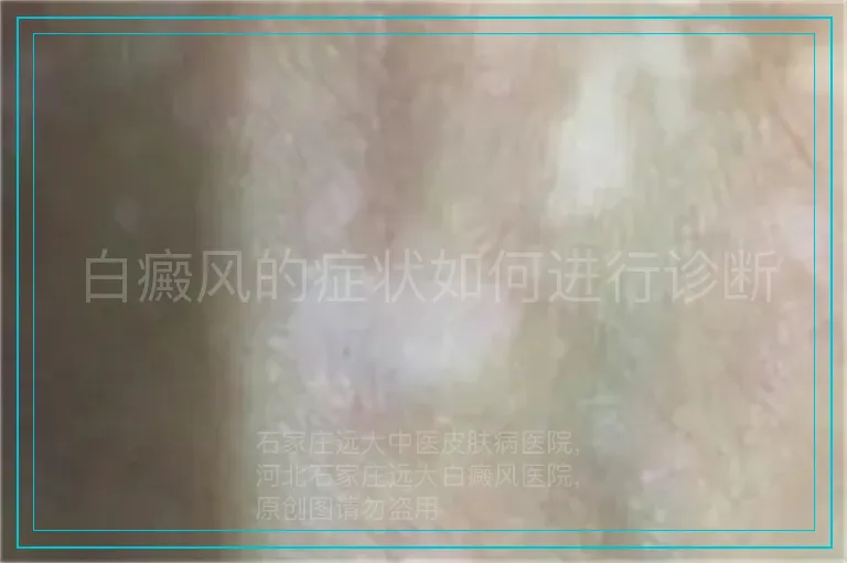 白癜风的症状如何进行诊断