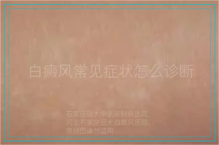 白癜风常见症状怎么诊断