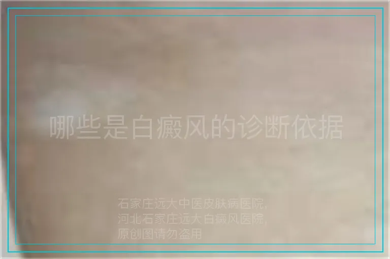 哪些是白癜风的诊断依据