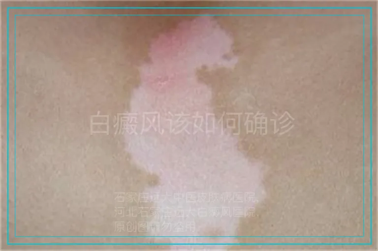 白癜风该如何确诊