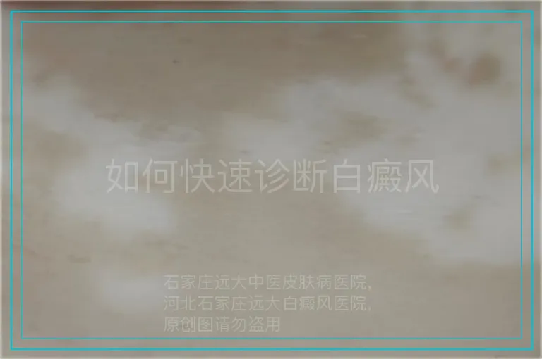 如何快速诊断白癜风