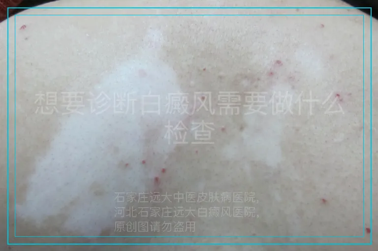 想要诊断白癜风需要做什么检查