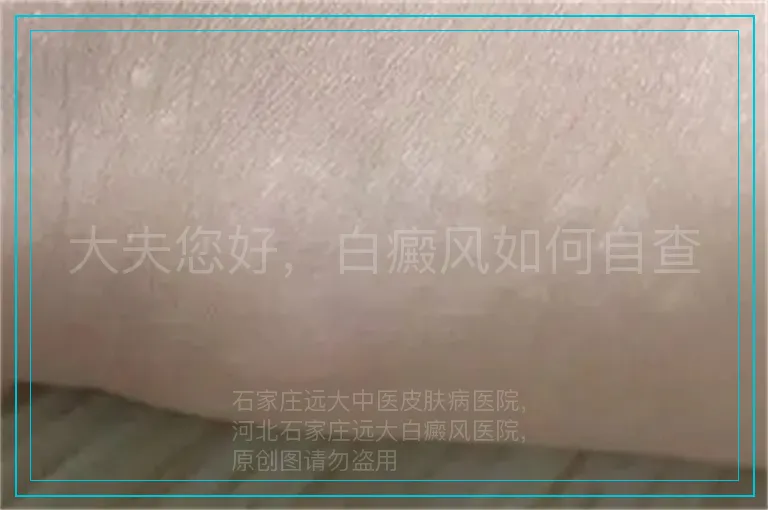 大夫您好，白癜风如何自查