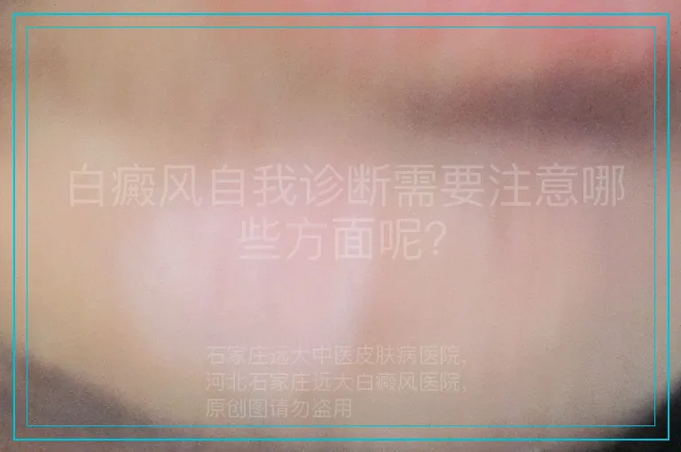 白癜风自我诊断需要注意哪些方面呢？