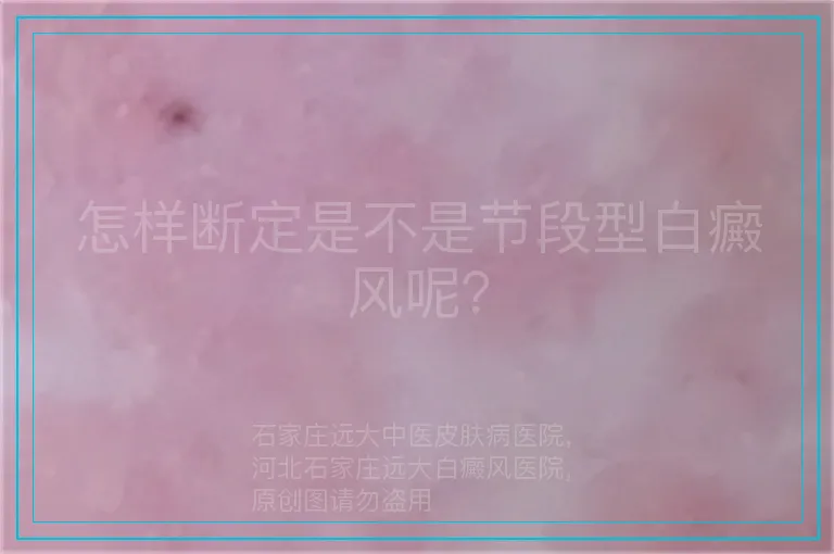 怎样断定是不是节段型白癜风呢？