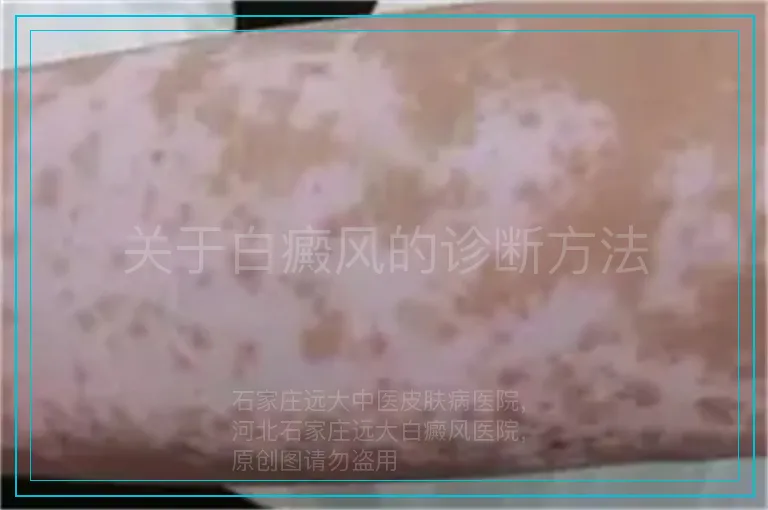 关于白癜风的诊断方法