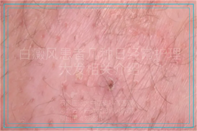 白癜风患者几种日经常护理大发相关介绍