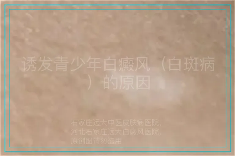 诱发青少年白癜风（白斑病）的原因