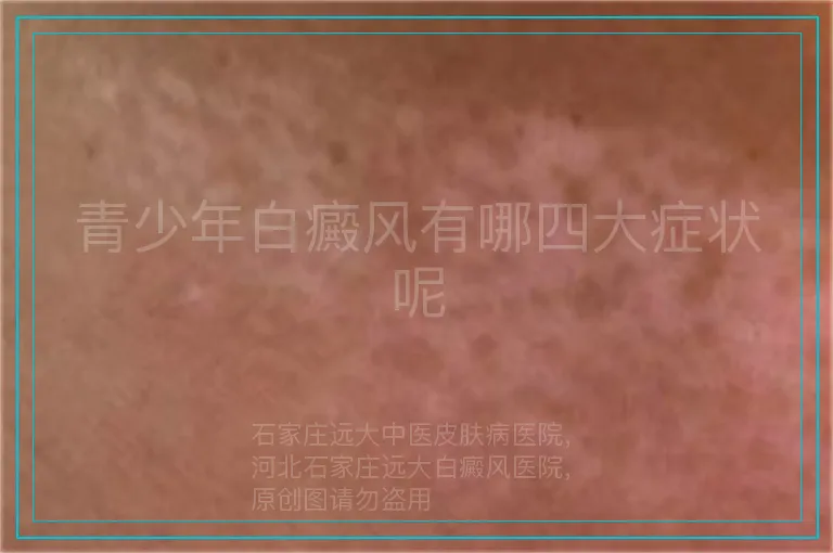 青少年白癜风有哪四大症状呢