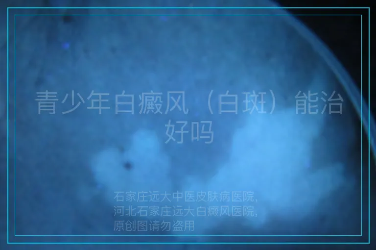 青少年白癜风（白斑）能治好吗
