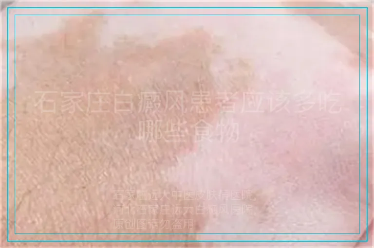 石家庄白癜风患者应该多吃哪些食物