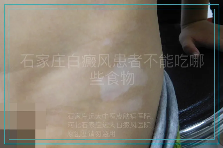 石家庄白癜风患者不能吃哪些食物