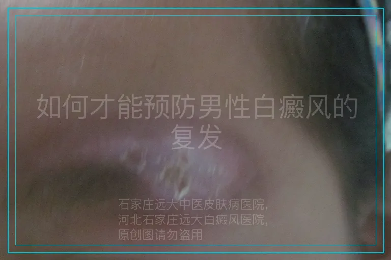 如何才能预防男性白癜风的复发