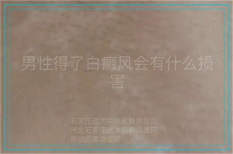 男性得了白癜风会有什么损害