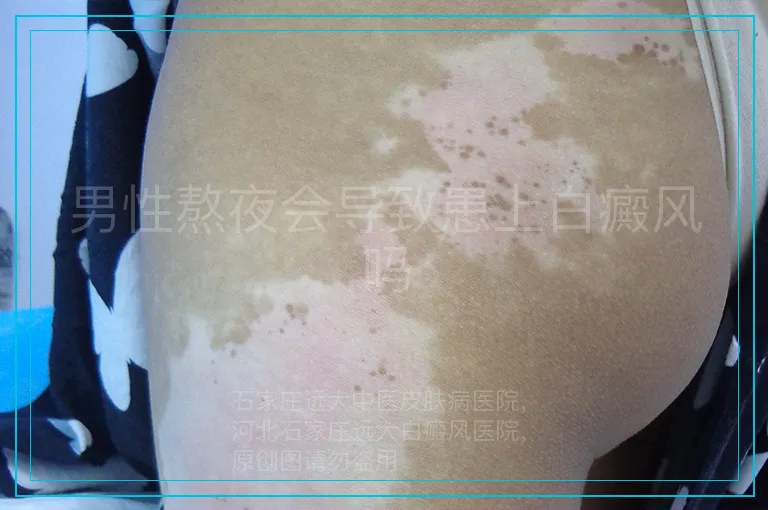 男性熬夜会导致患上白癜风吗