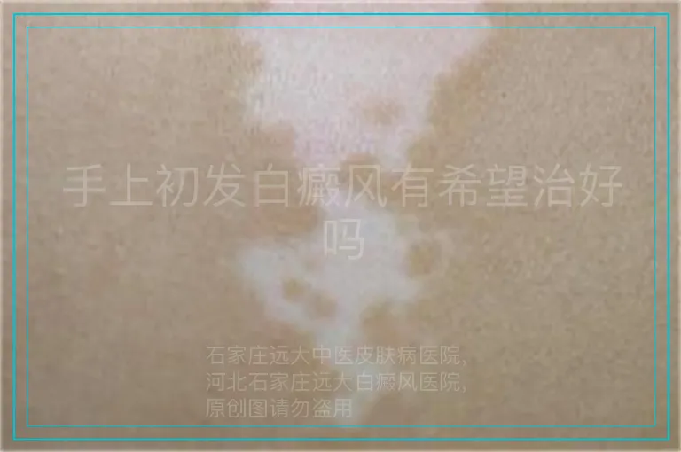 手上初发白癜风有希望治好吗