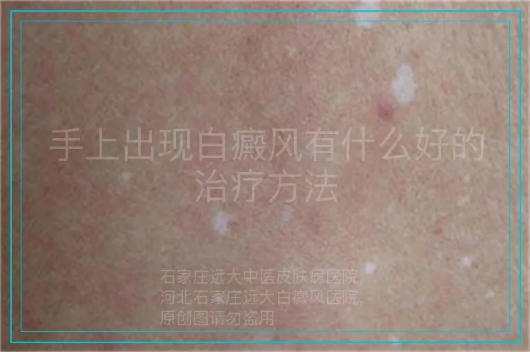 手上出现白癜风有什么好的治疗方法