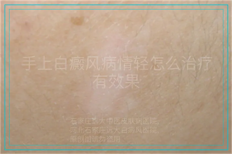 手上白癜风病情轻怎么治疗有效果