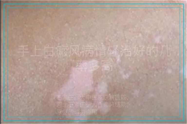 手上白癜风病情轻治好的几率多高