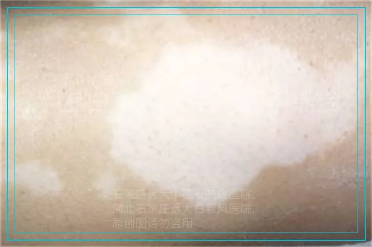 手上白癜风病情轻能不能治好