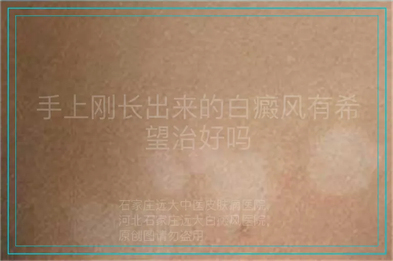 手上刚长出来的白癜风有希望治好吗
