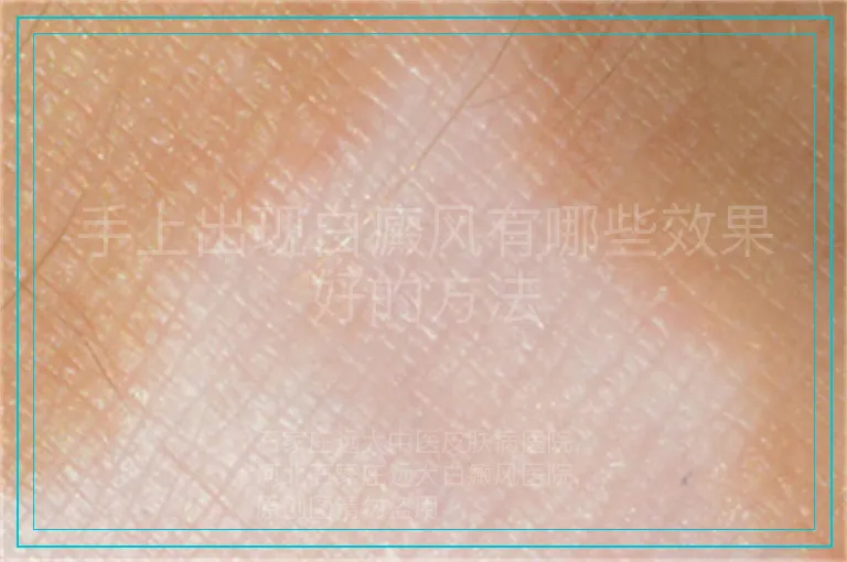 手上出现白癜风有哪些效果好的方法