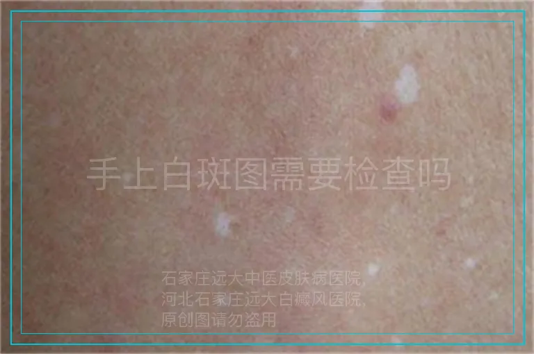 手上白斑图需要检查吗