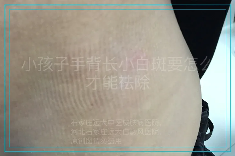 小孩子手背长小白斑要怎么才能祛除