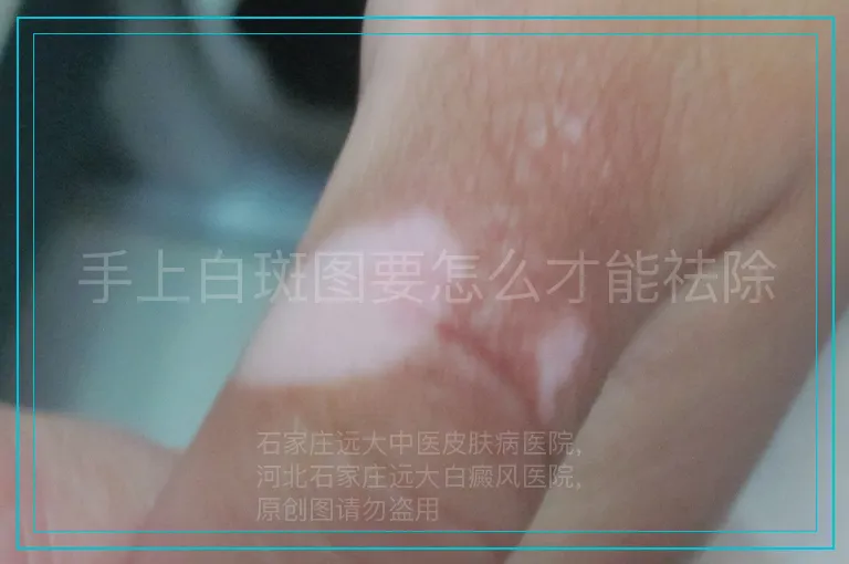 手上白斑图要怎么才能祛除