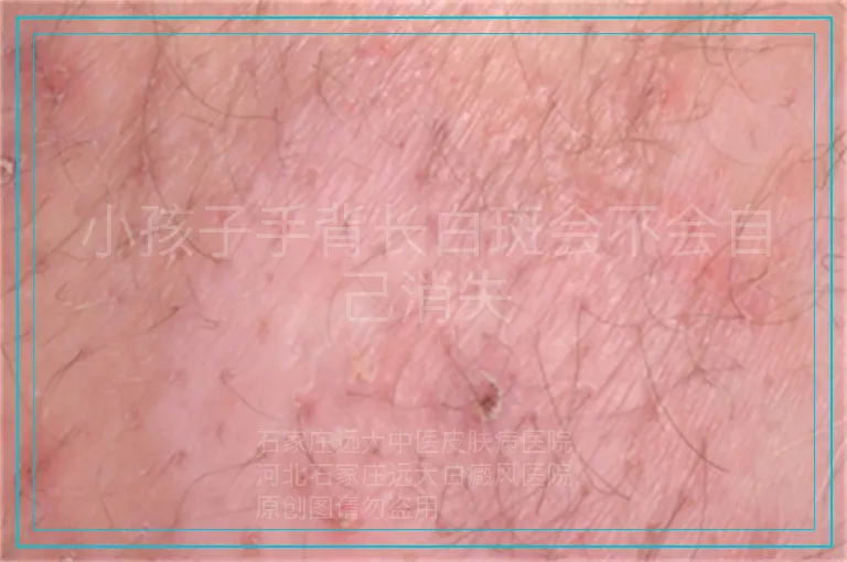 小孩子手背长白斑会不会自己消失