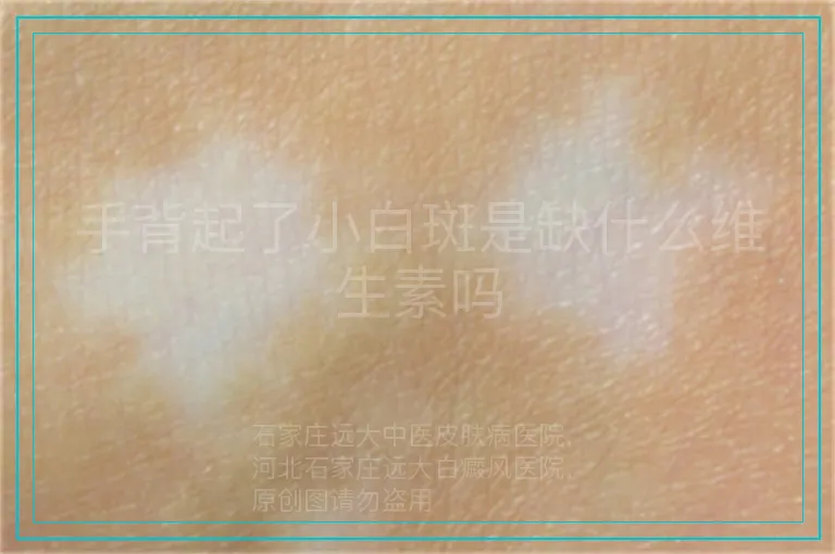 手背起了小白斑是缺什么维生素吗