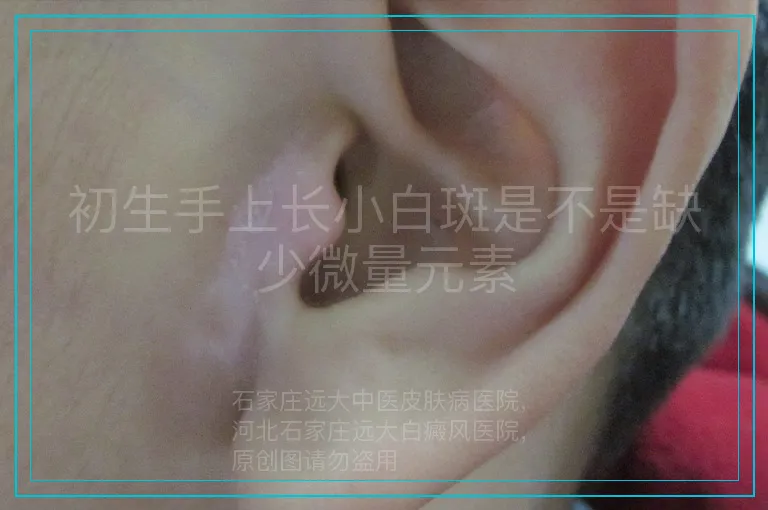 初生手上长小白斑是不是缺少微量元素