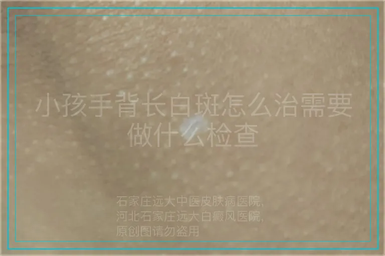 小孩手背长白斑怎么治需要做什么检查