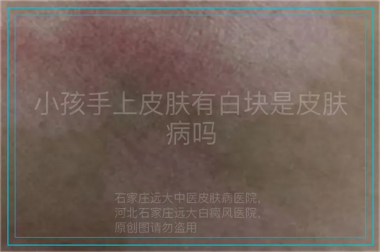 小孩手上皮肤有白块是皮肤病吗