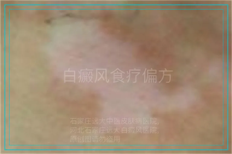 白癜风食疗偏方