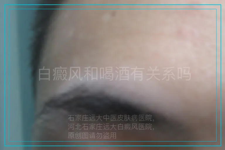 白癜风和喝酒有关系吗