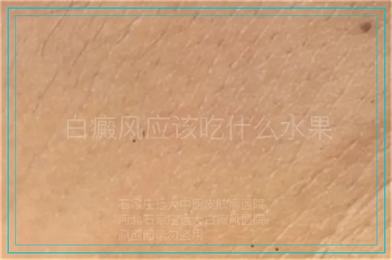 白癜风应该吃什么水果
